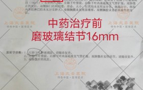 16MM磨玻璃结节最好的治疗方法？上海太安医院用真实案例告诉您！