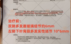 磨玻璃结节最好的治愈方法：动力温控经皮给药，1个月好转！